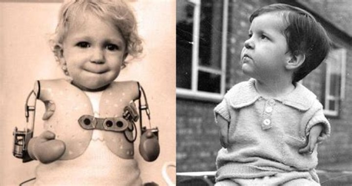Are any thalidomide babies still alive?