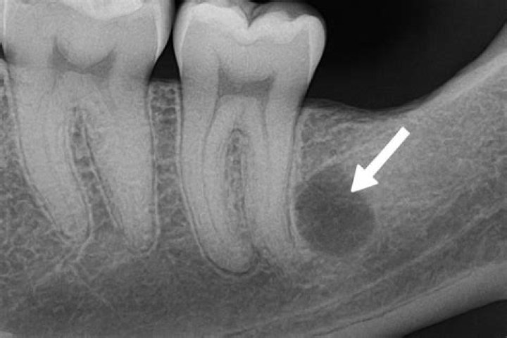 Can abscessed tooth cause sinus infection?