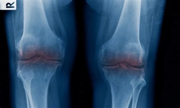 Can arthritis be reversed?