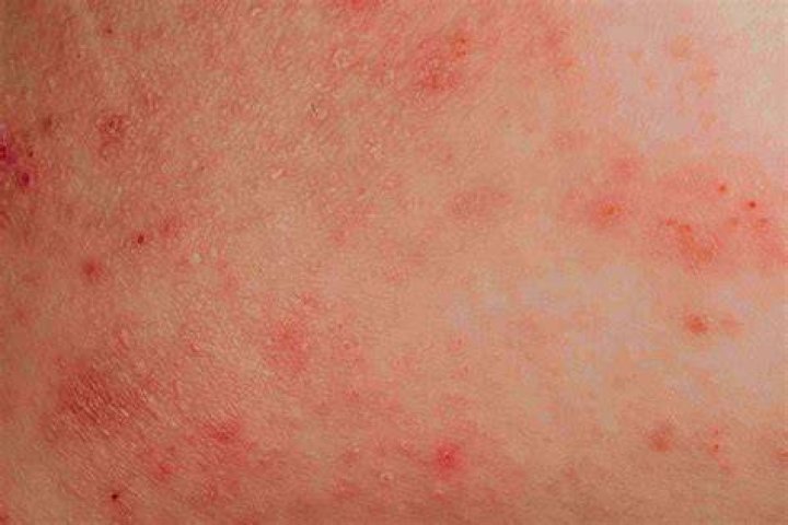 Can eczema be spotty?