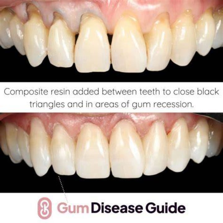 Can teeth be inserted?