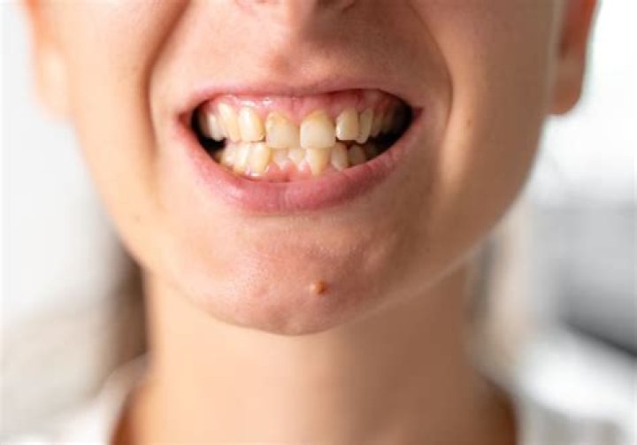 Can you get sharper canine teeth?