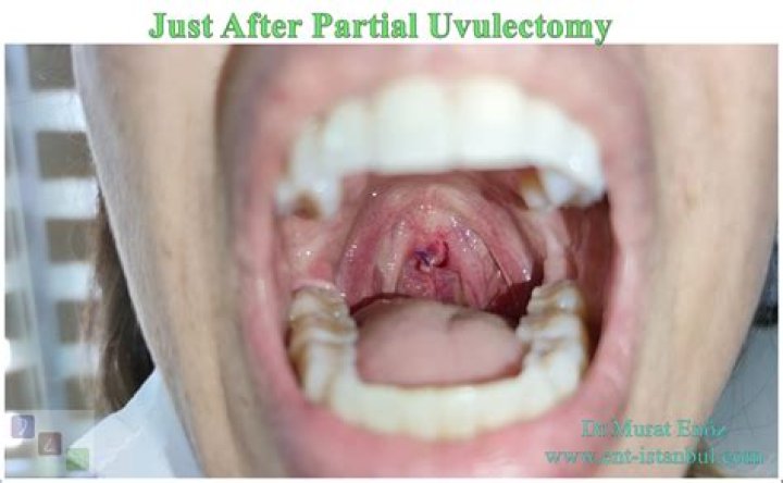 Can you get your uvula removed?