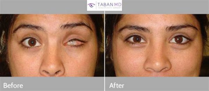 Can you see after enucleation?