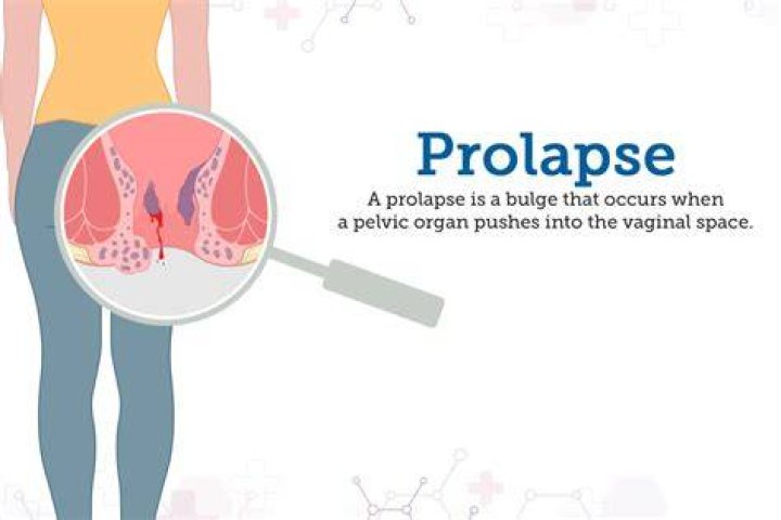 Could i have a prolapse?