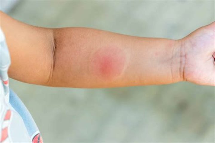 Do botfly bites itch?