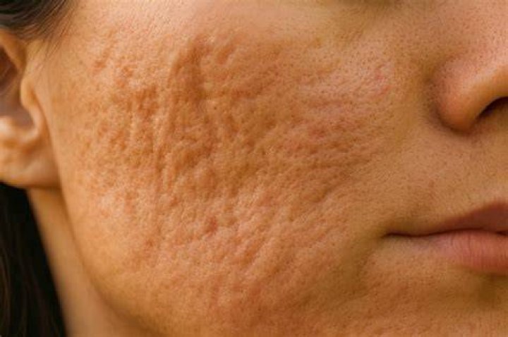 Do pockmarks get worse with age?