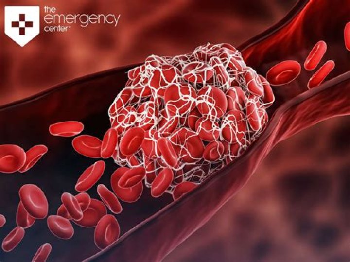 Does blood clots move?