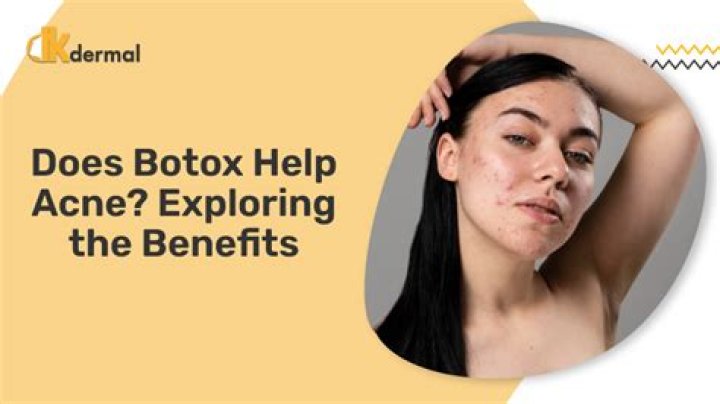 Does botox help acne?