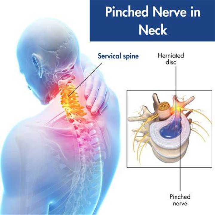 Does pinched nerve in neck go away?