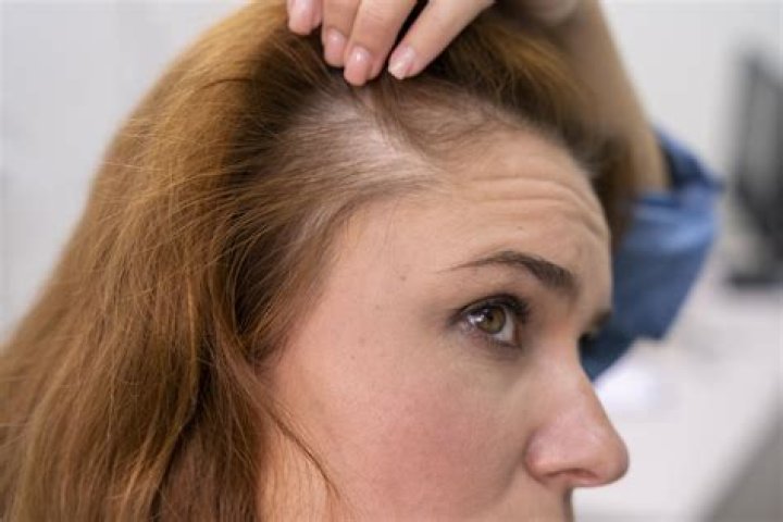 Does serum cause hair loss?