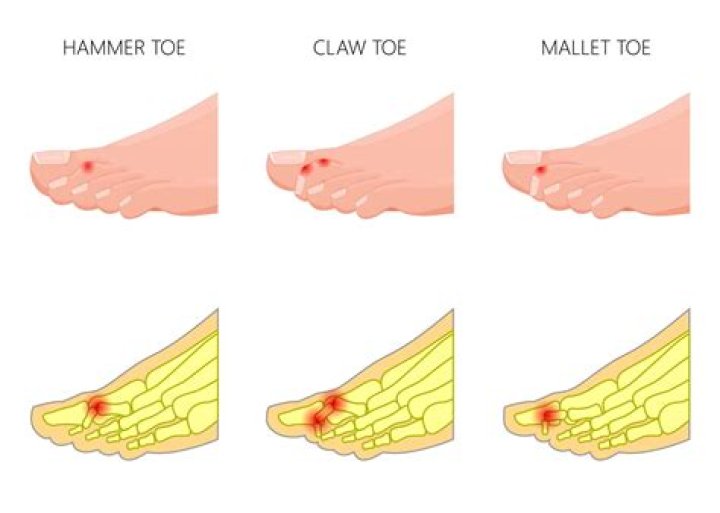 How do hammertoes form?