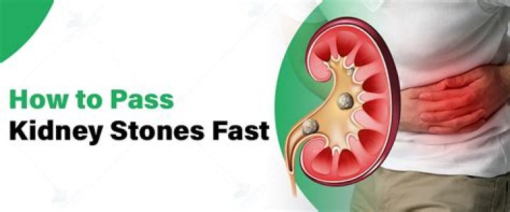 How long to pass a kidney stone?