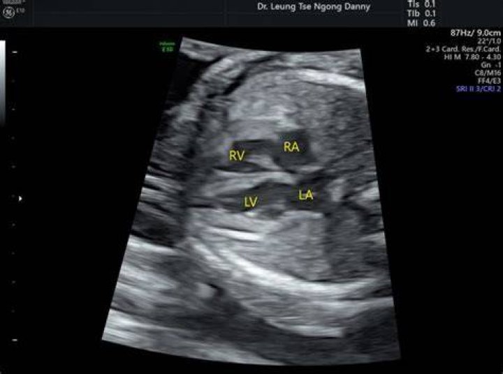 Is echogenic intracardiac focus normal?