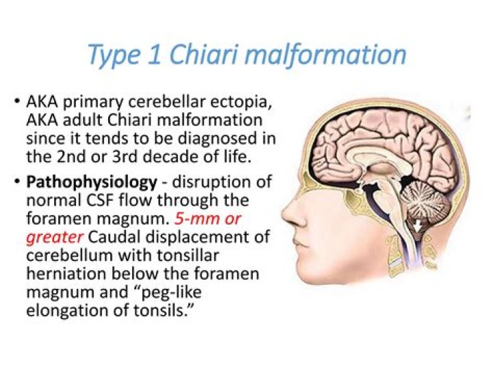 Is having a chiari malformation life threatening?