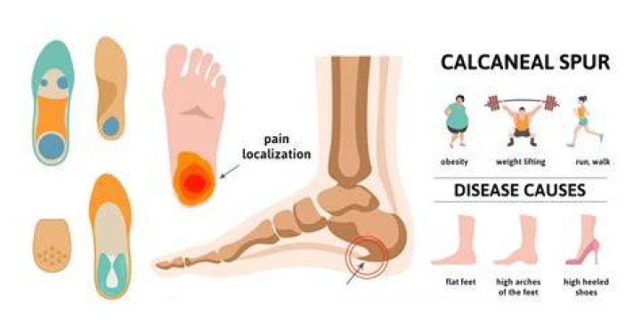 What calcaneal spur means?