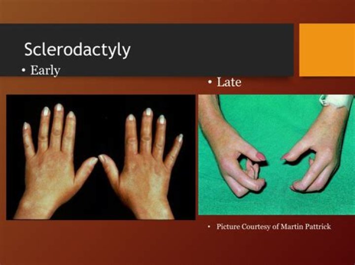 What does sclerodactyly mean?