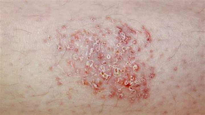 What is dermatomal vesicular disease?