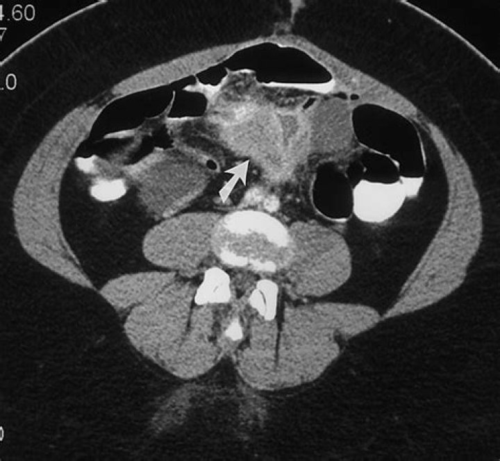 What is mesenteric cancer?