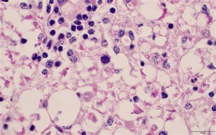 What is protozoal myeloencephalitis?