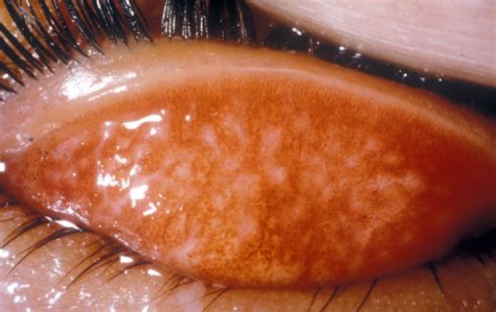 What is trachomatous scarring?