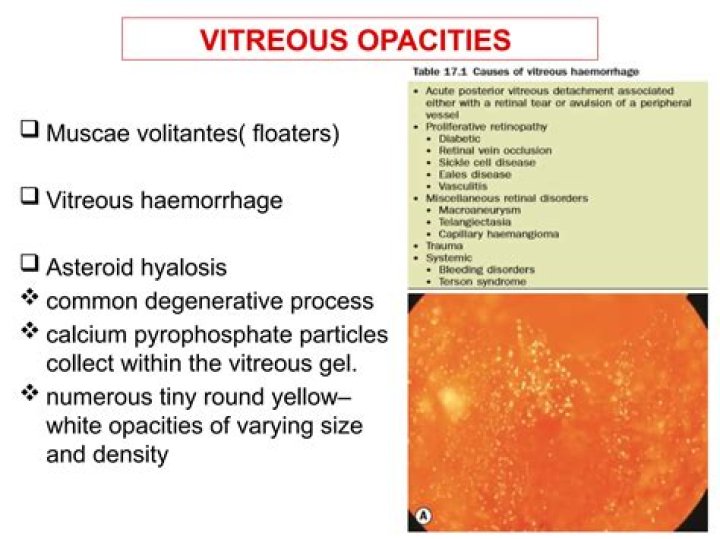 What is vitreous opacities?