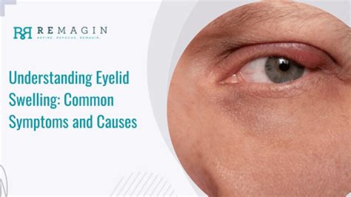 What makes your eyes swollen?