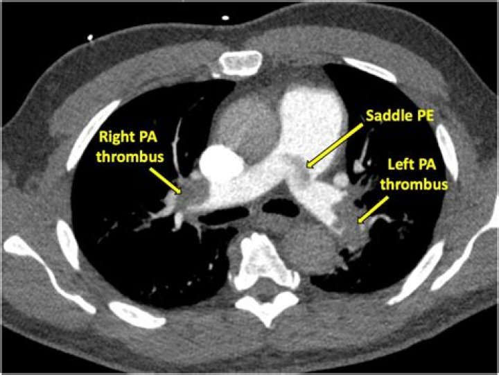 Whats a saddle embolus?