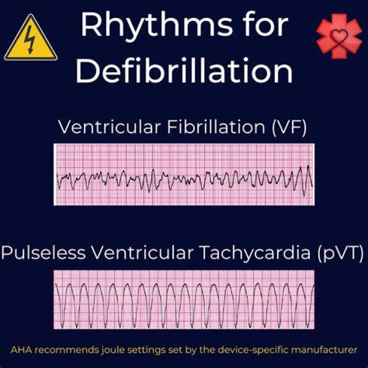 When do we defibrillate?