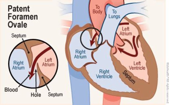 When should foramen ovale close?