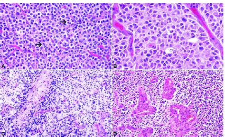 Where can oligodendroglioma be found?