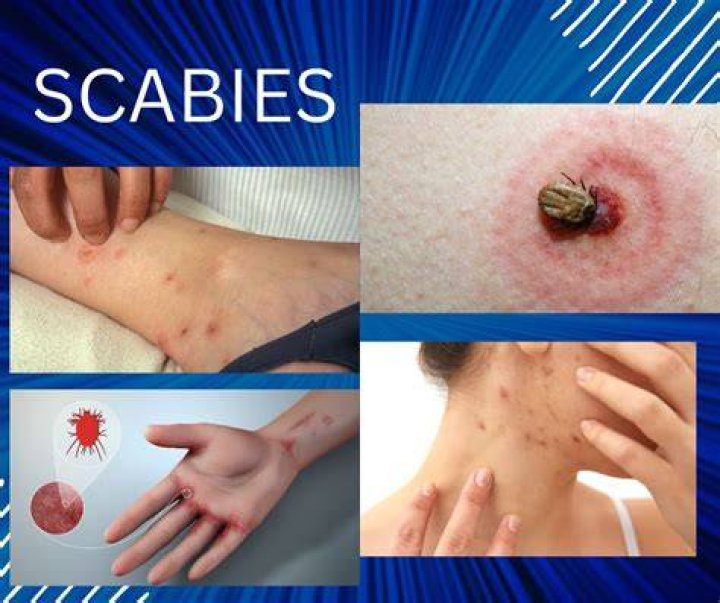 Who do you contract scabies?