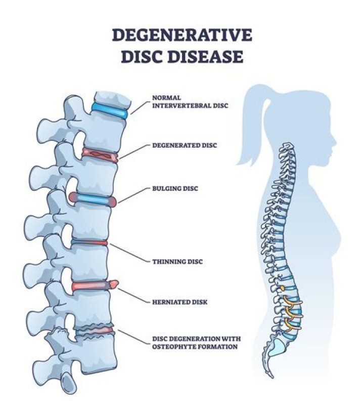 Why degenerative disc disease occurs?