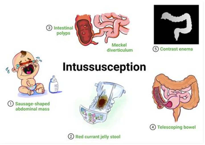 Why does intussusception happen?
