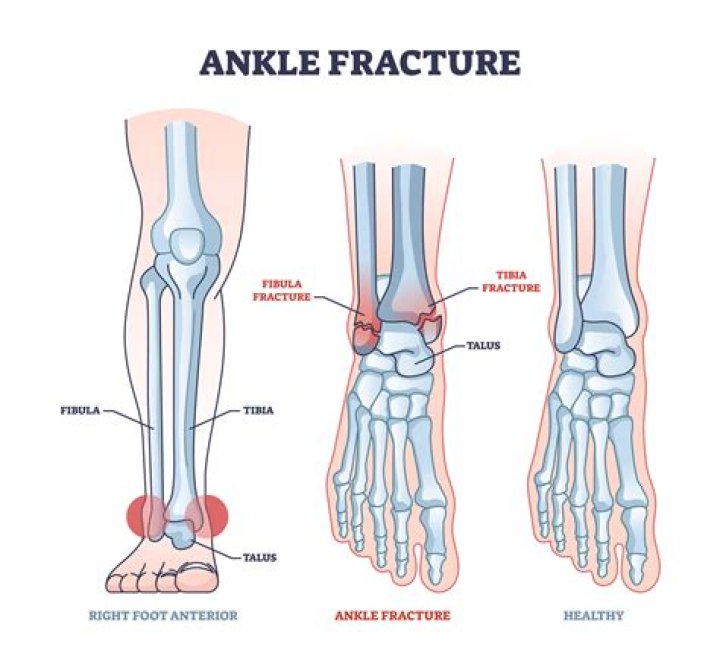 Will a fractured cusp heal?