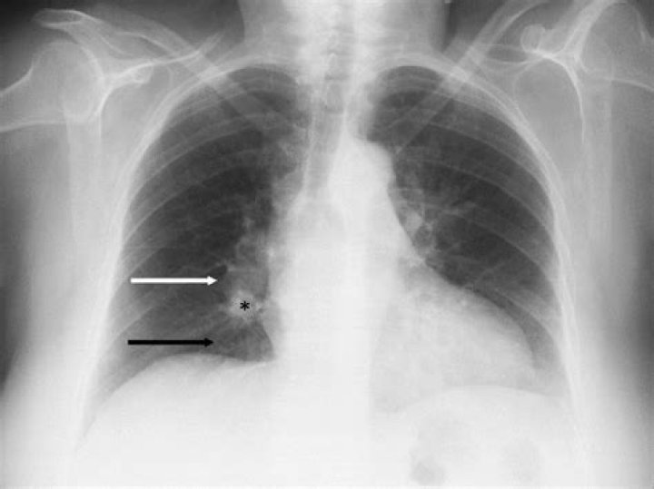 Will pulmonary embolism show on x ray?